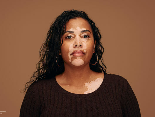FDA clears Incyte’s Opzelura for vitiligo launch; analysts temper blockbuster hopes