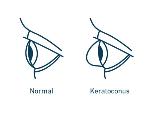 Glaukos urges young adults to stop rubbing, start seeing keratoconus symptoms