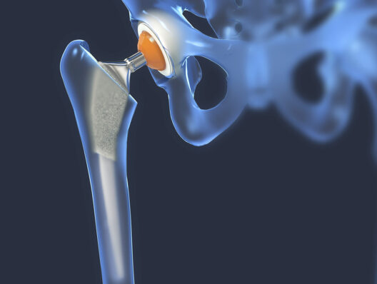 Thousands got Exactech knee or hip replacements. Then, patients say, the parts began to fail