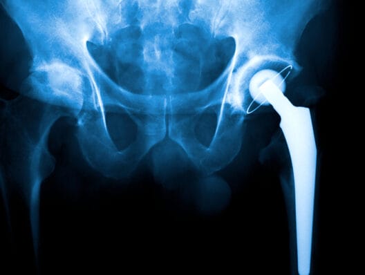Patients expected profemur artificial hips to last. Then they snapped in half.