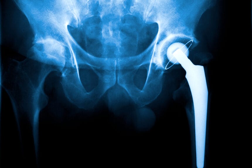 An X Ray of a hip joint problem