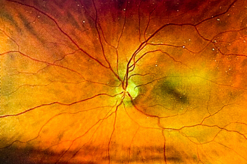 An image of a human retina taken during an eye exam